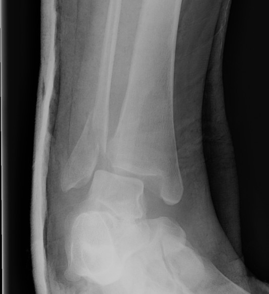 Ankle Weber B Fracture